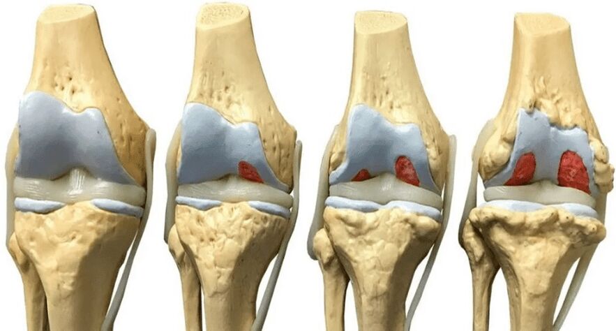 OstyHealth prévient la destruction du cartilage