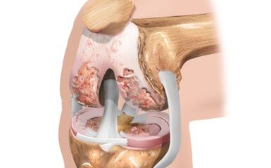 Arthrose de l'articulation du genou