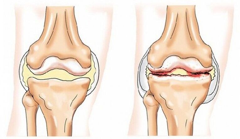 Articulations et articulations saines affectées par l'arthrose
