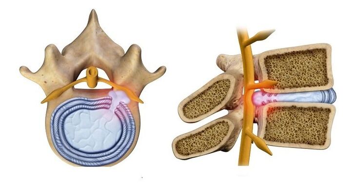 Hernie discale – renflement du noyau discal dans le canal rachidien